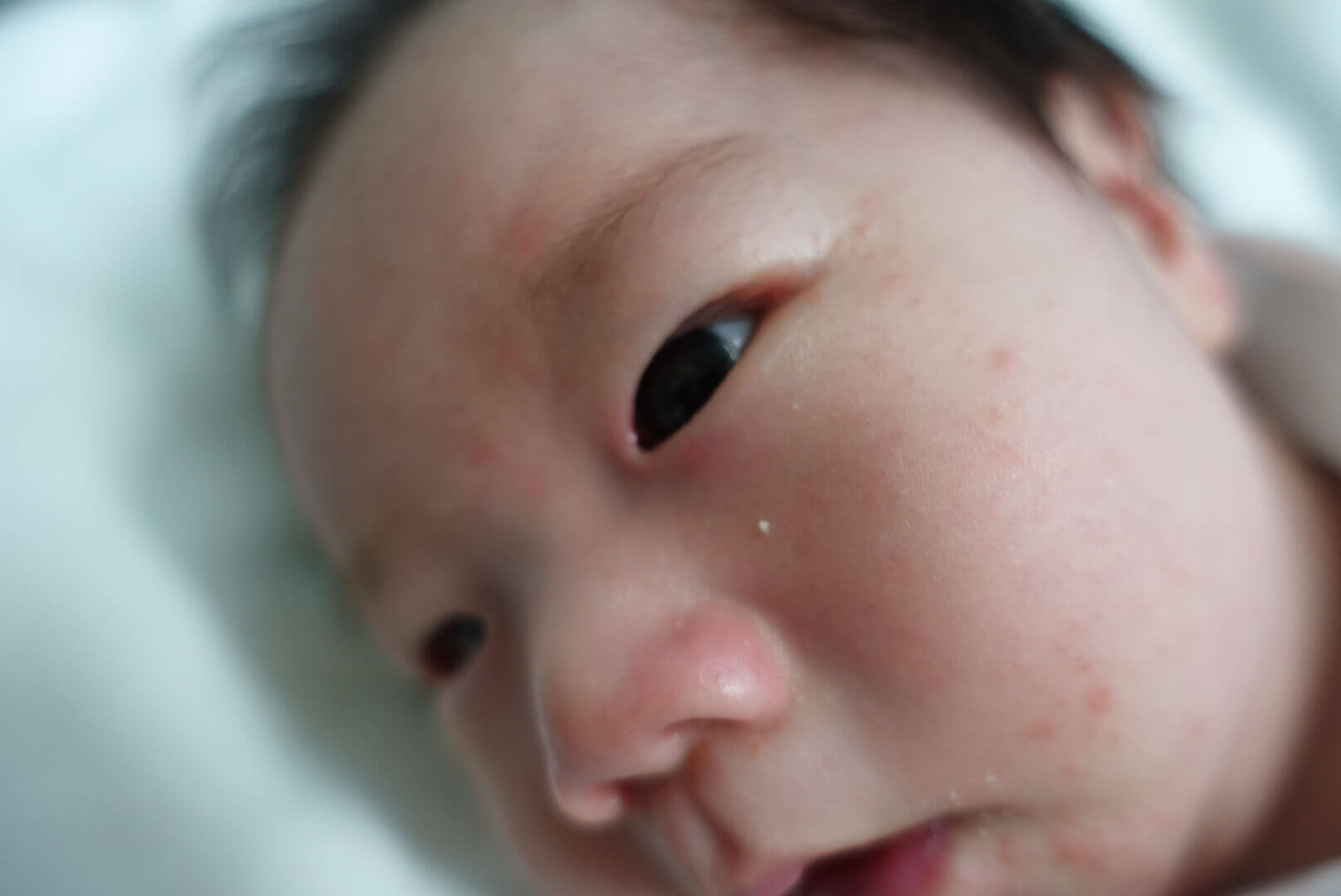 乳児湿疹ができた赤ちゃんの顔